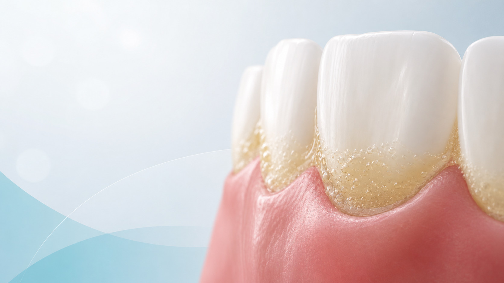 Simplified close-up illustration of a soft, translucent plaque layer collecting near the gumline.